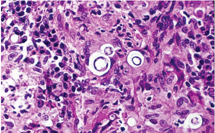 Blastomycosis Histology